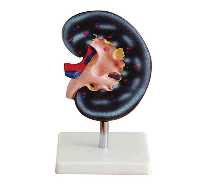 enlarged-kidney-2-times-2-pieces-image